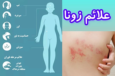 علائم بیماری زونا | راه های تشخیص، پیشگیری و درمان آن