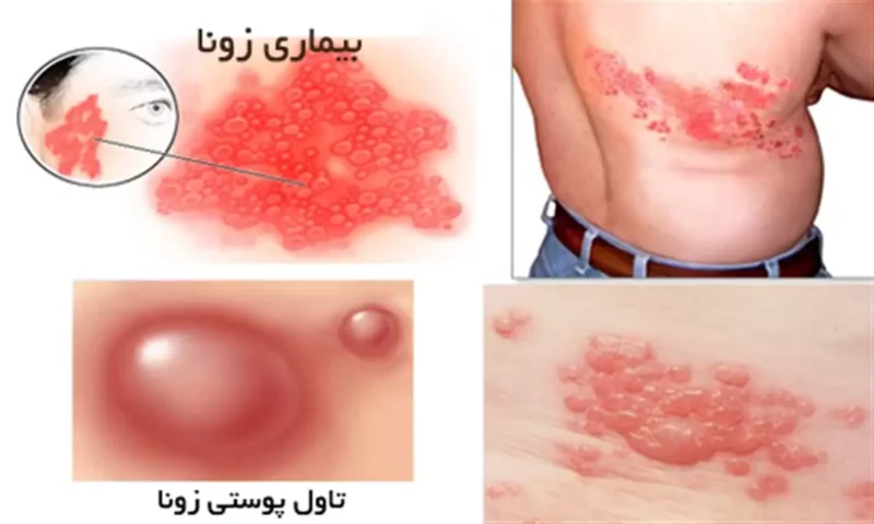 علائم بیماری زونا | راه های تشخیص، پیشگیری و درمان آن