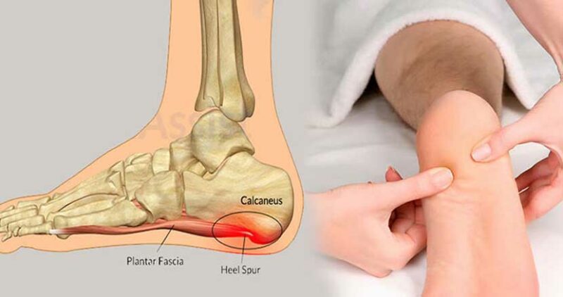 خار پاشنه چیست و چه علائمی دارد؟
